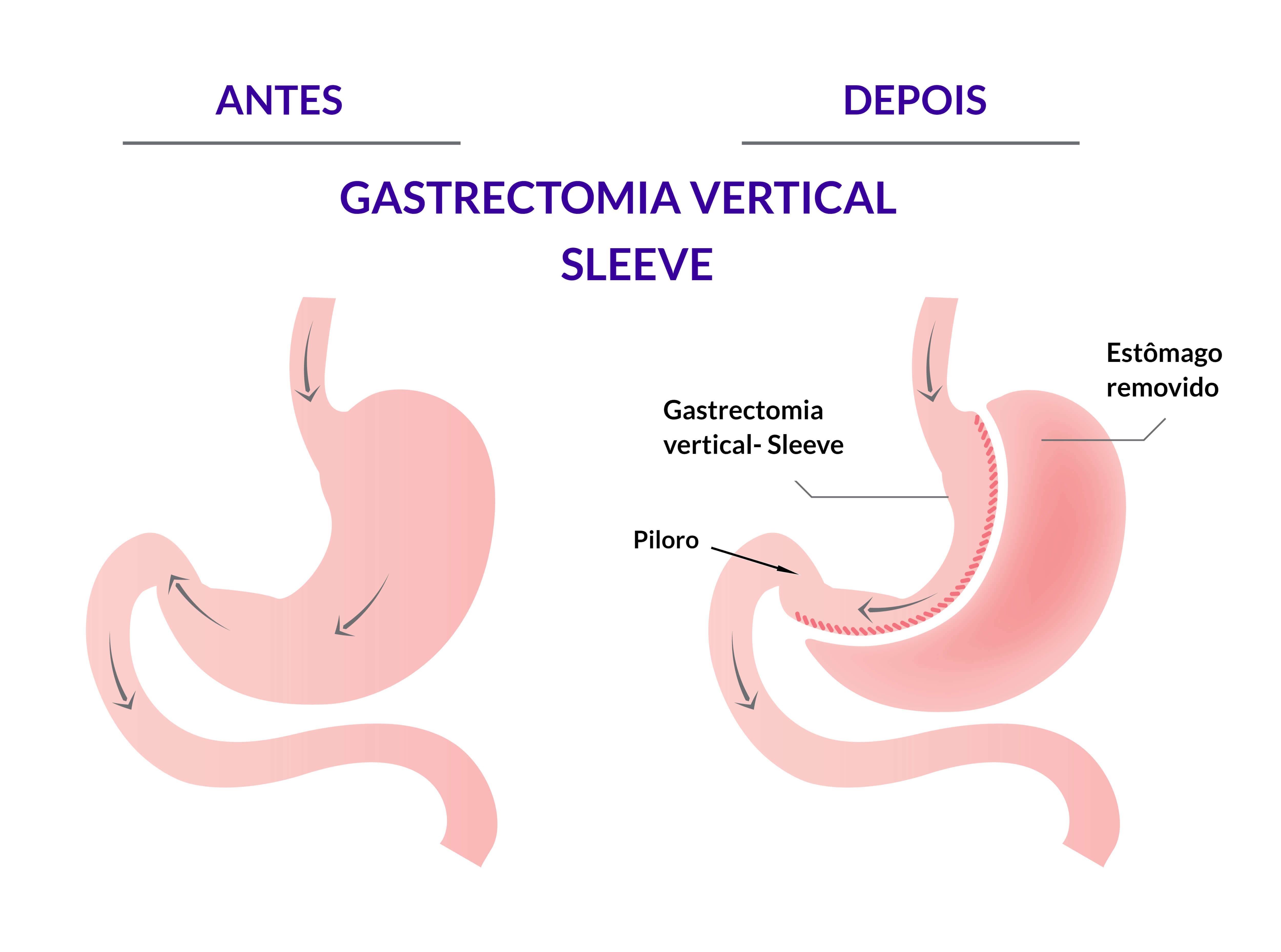 SLEEVE - Gastrectomia vertical